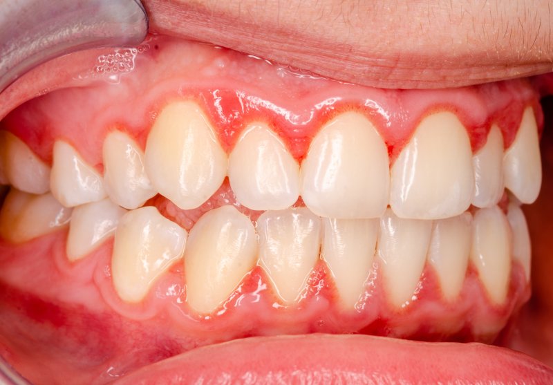 close-up view of a person with gum disease 